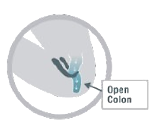 Col&oacute;n abierto 